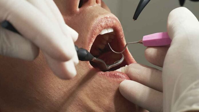 Una caries no atendida puede derivar en tratamientos que cuestan hasta 30 mil pesos por diente